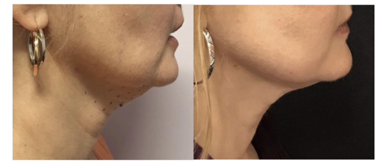 neck lipo vs kybella