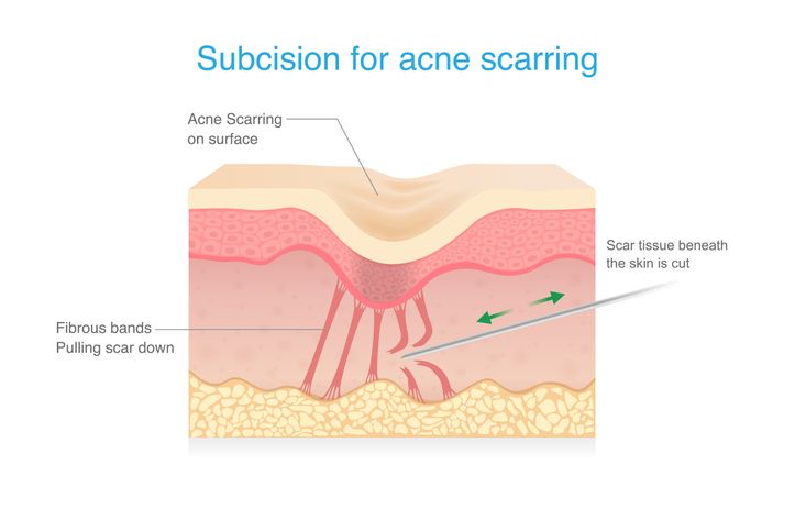 Mount Castle Medspa - What Is Subcision?
