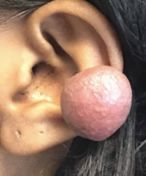 Mount Castle Medspa - A Breakthrough Approach to Keloid Treatment: Combination Therapy That Works