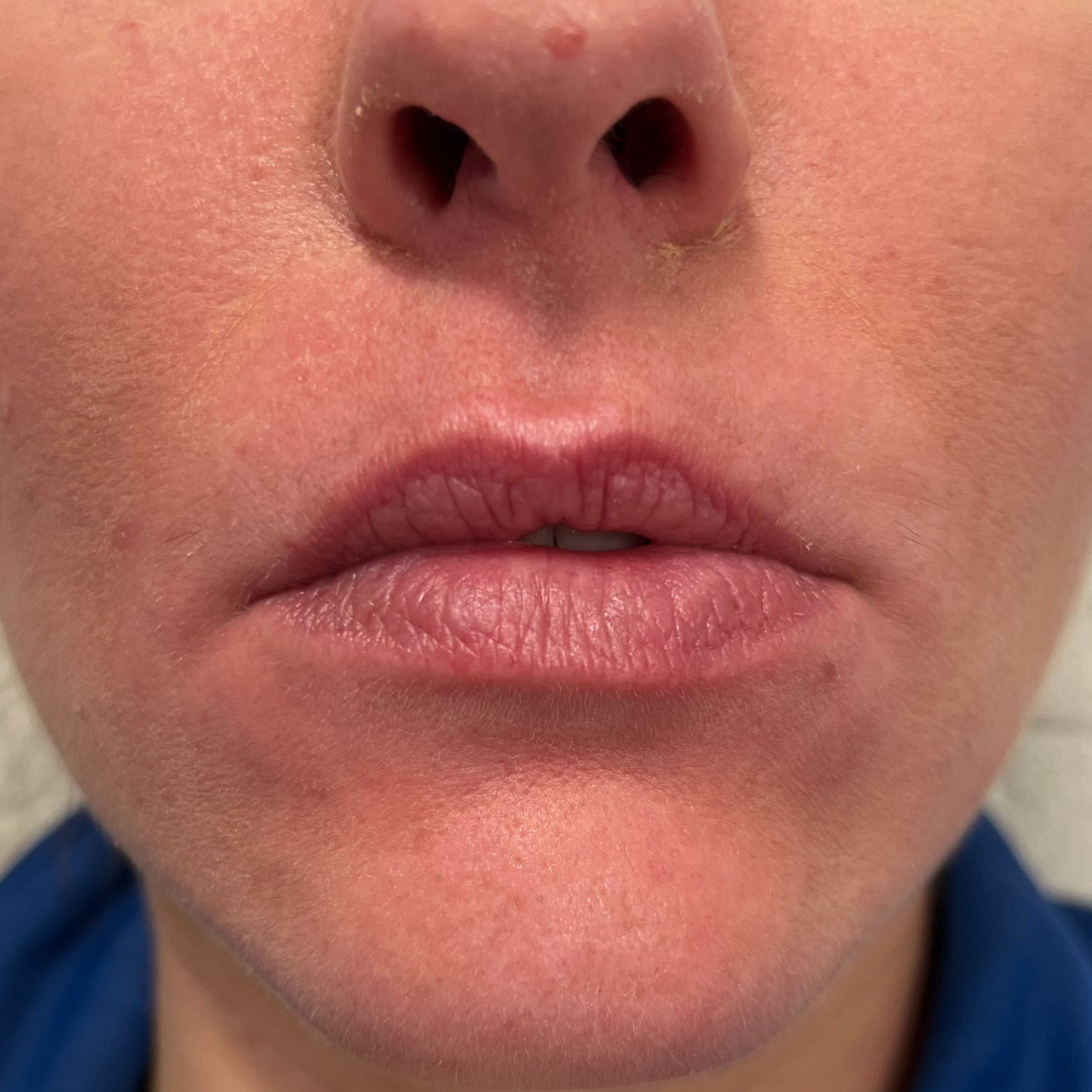 Lip Filler Before Patient 1