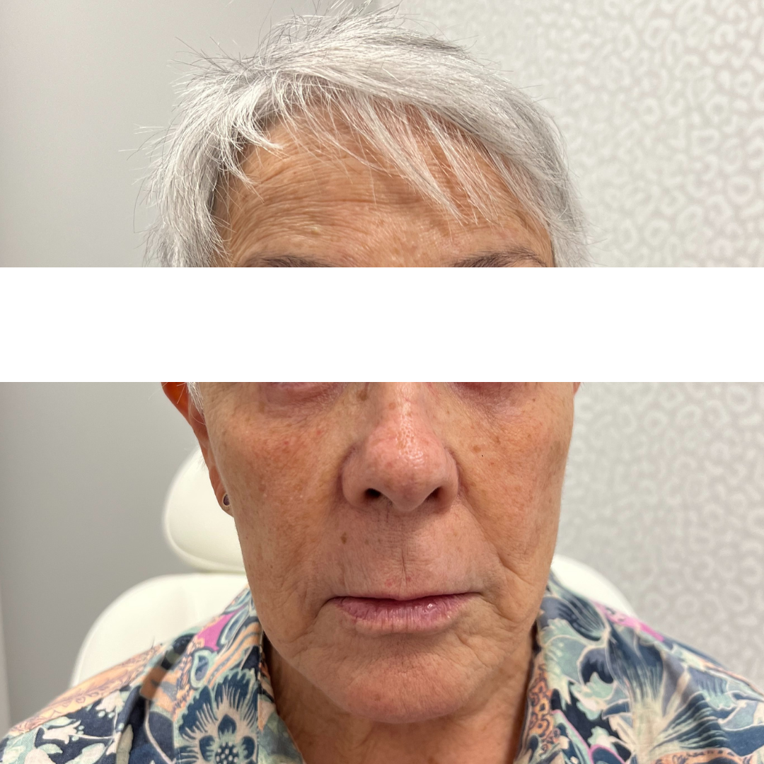 Cheek Filler Before Patient 3