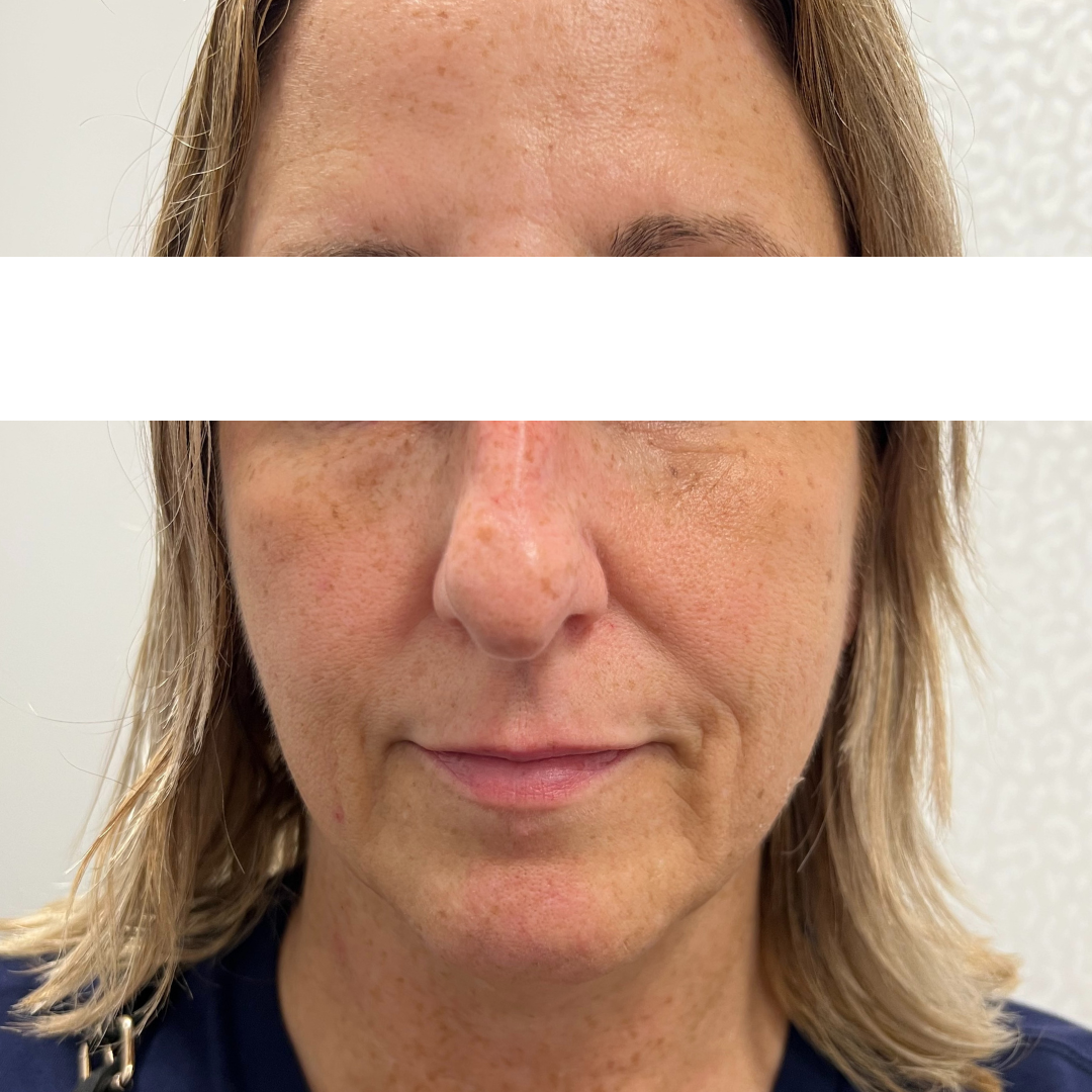 Cheek Filler Before Patient 4