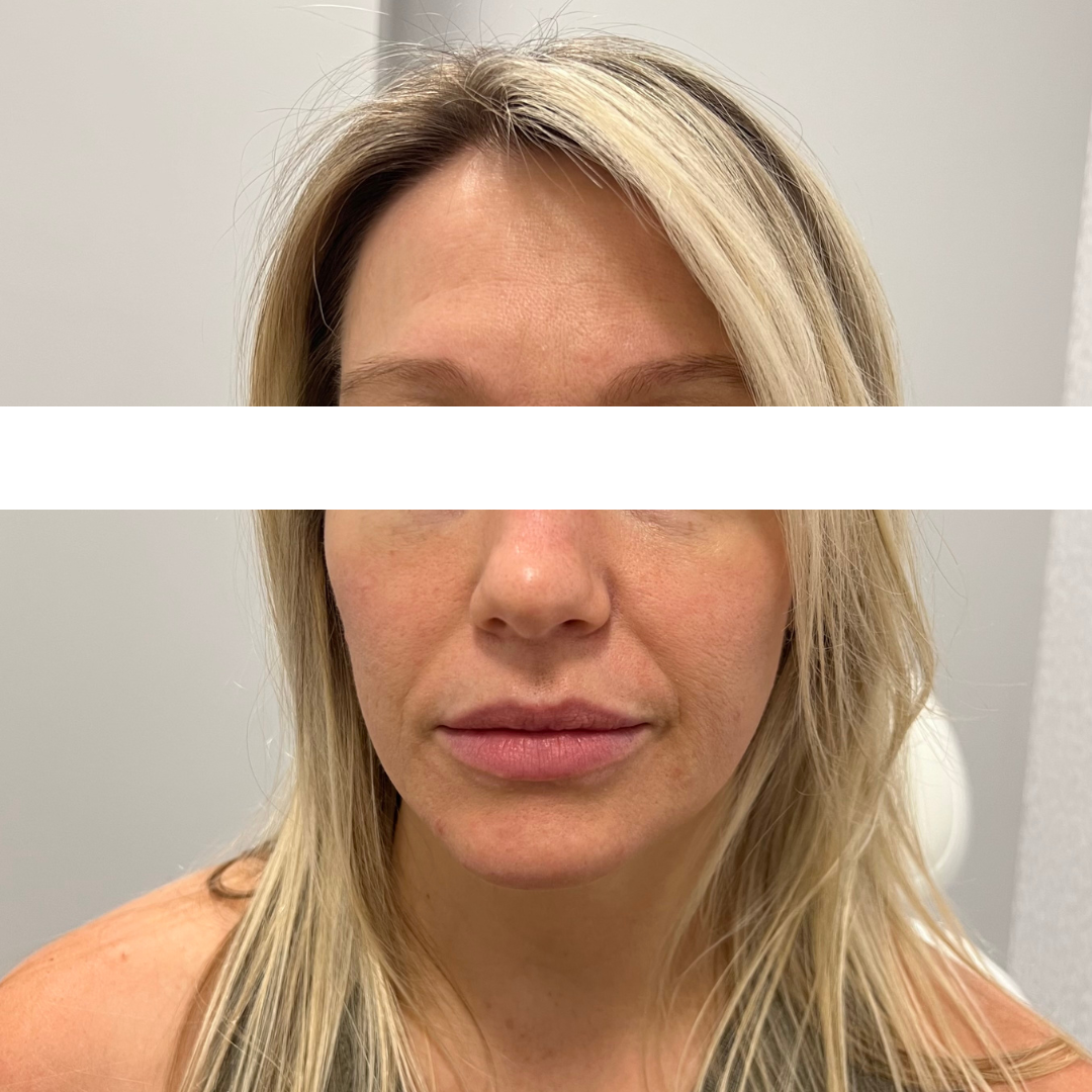 Cheek Filler Before Patient 5