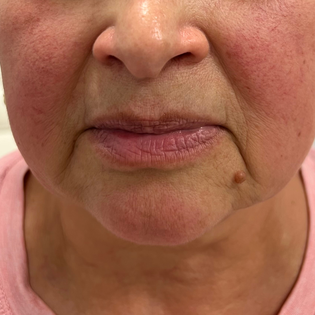 Lines Archives Mountcastle Medical Spa and Laser Center