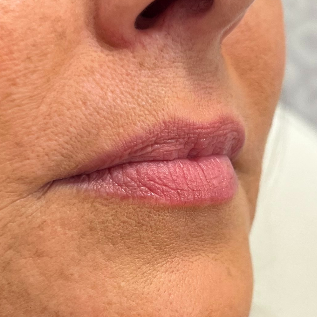 Lip Filler Before Patient 23
