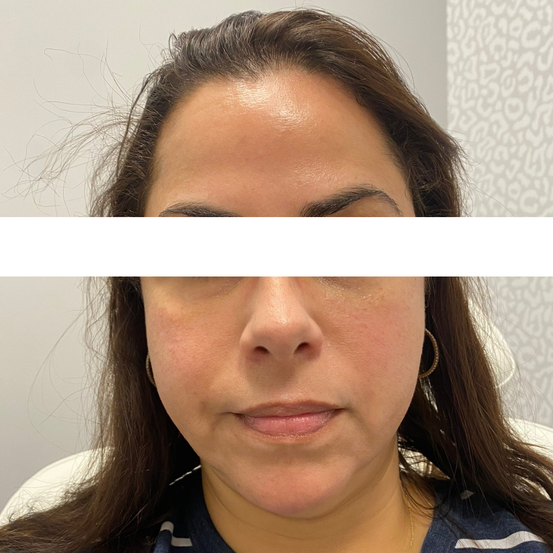 Cheek Filler Before Patient 6