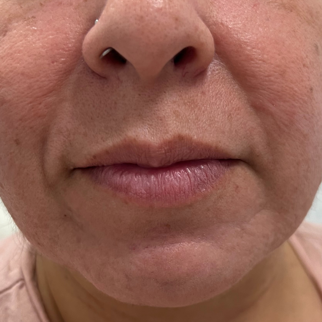 Lip Filler Before Patient 25