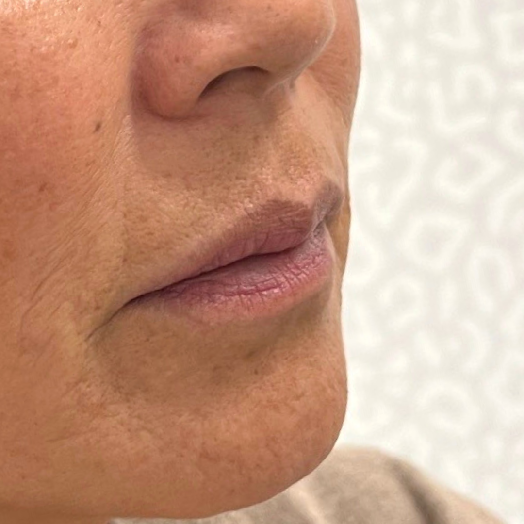 Lip Filler Before Patient 27