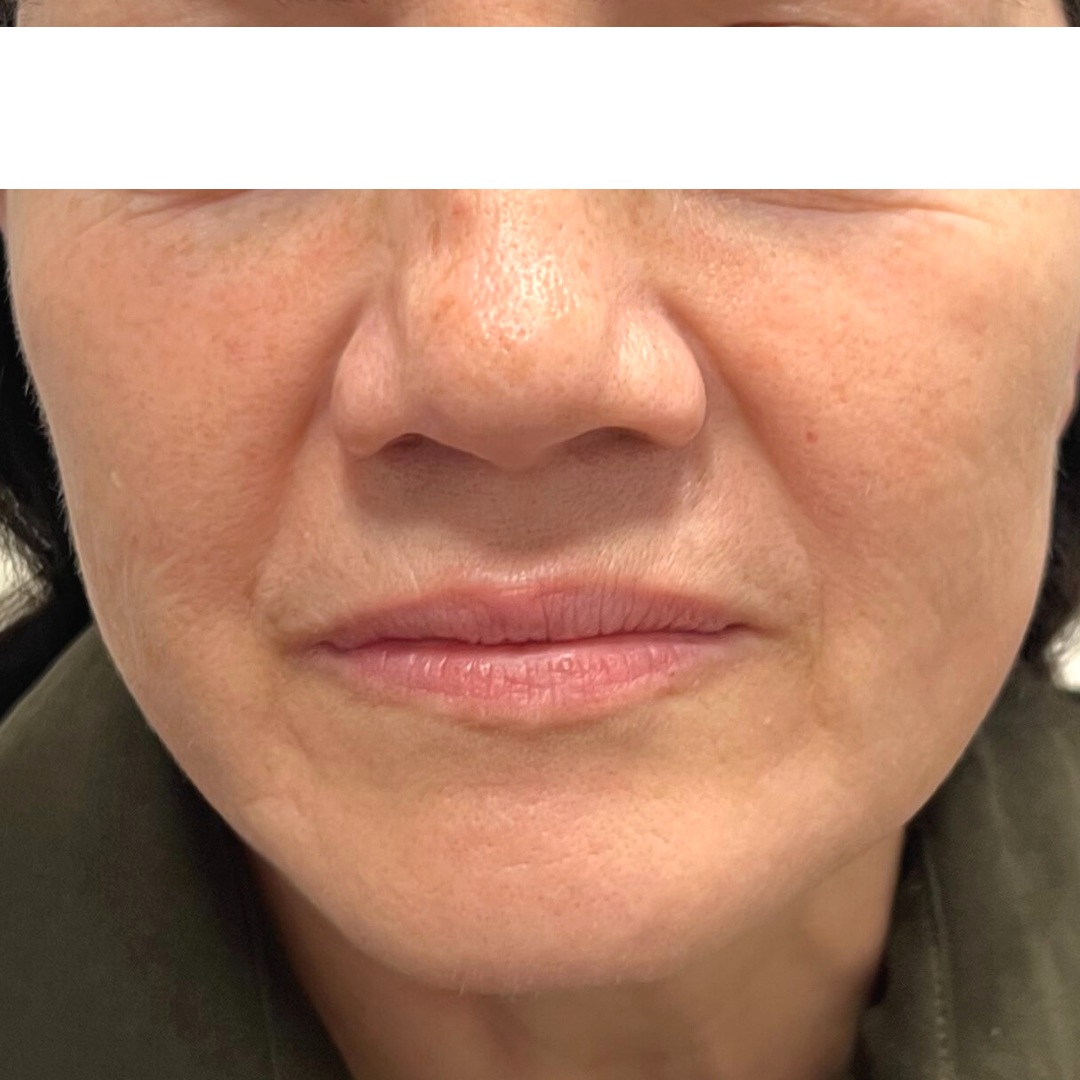 Nasolabial Folds Archives Mountcastle Medical Spa and Laser Center