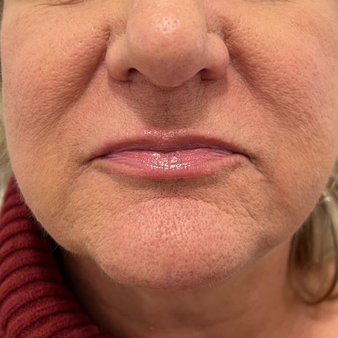 Lip Filler Before Patient 32