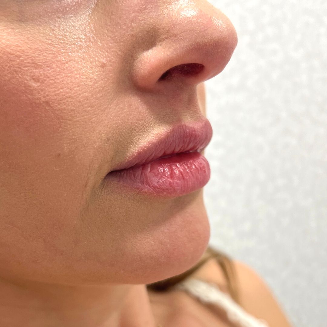 Lip Filler Before Patient 29