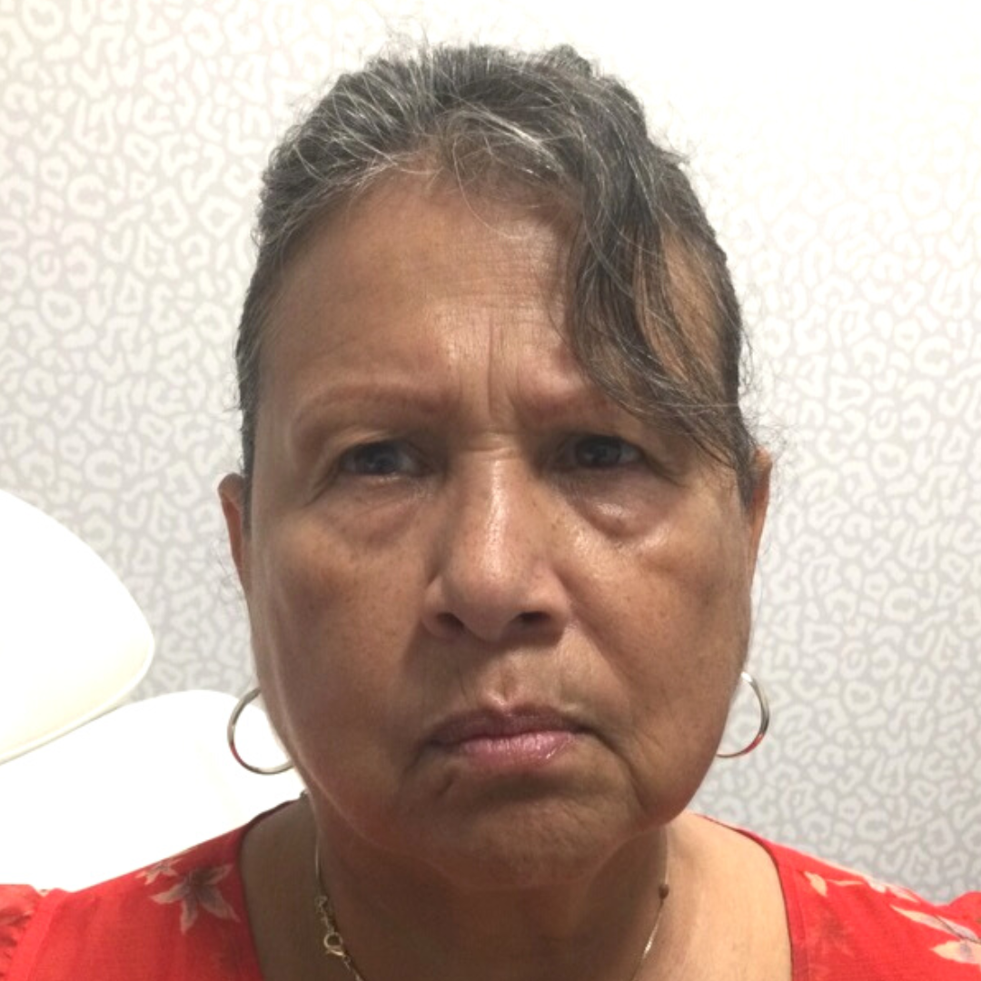 Botox and Dysport Before Patient 4