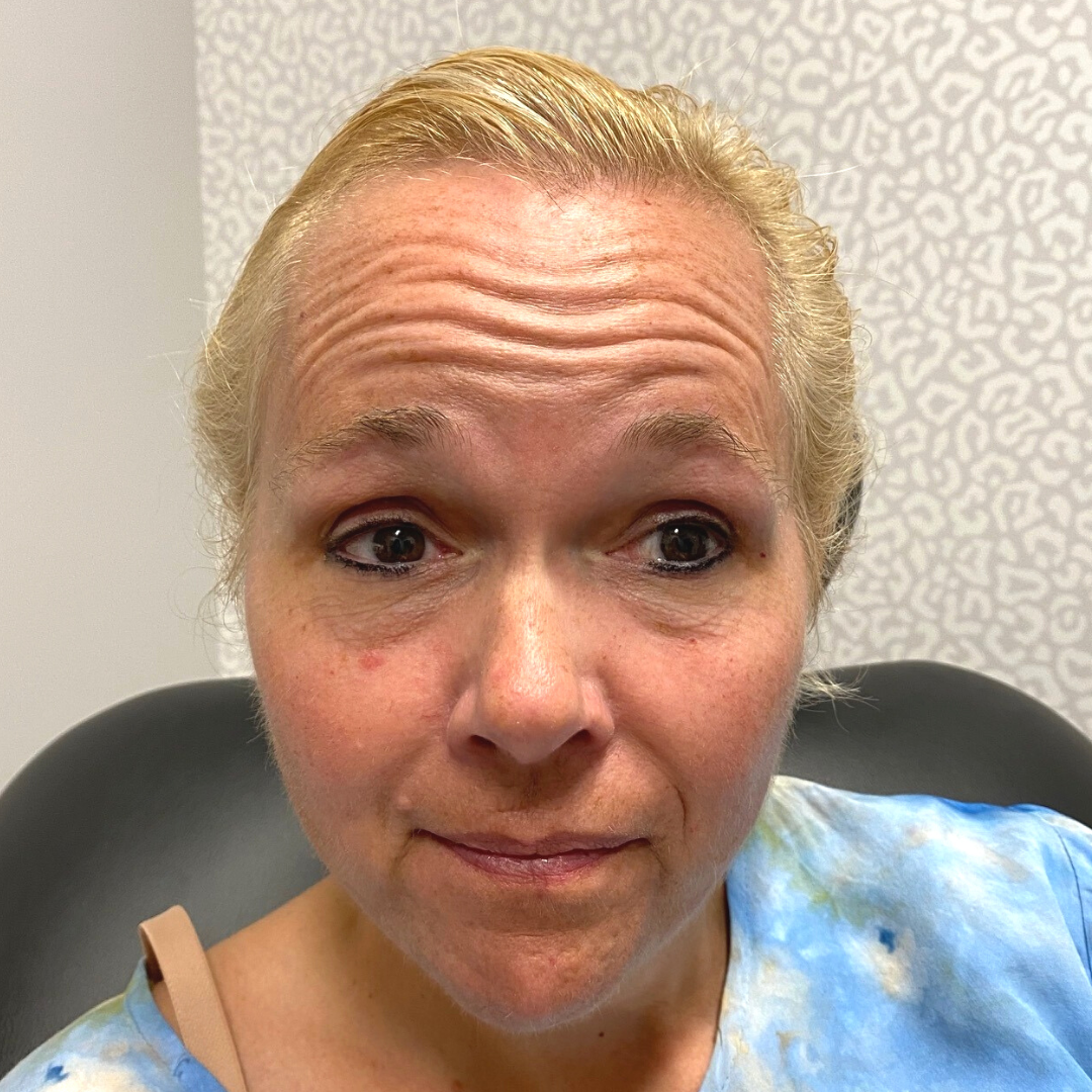 Injectables Before Patient 24