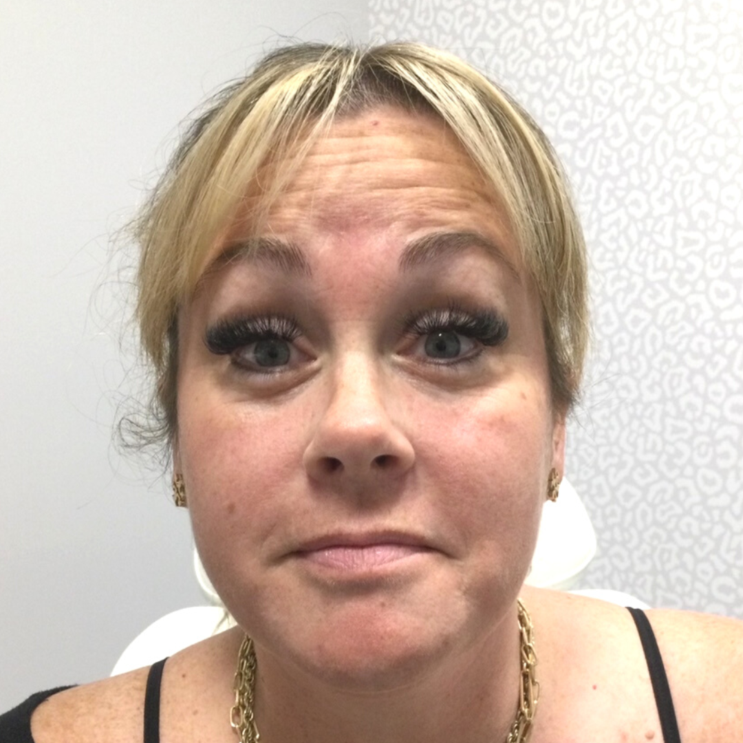 Injectables Before Patient 13