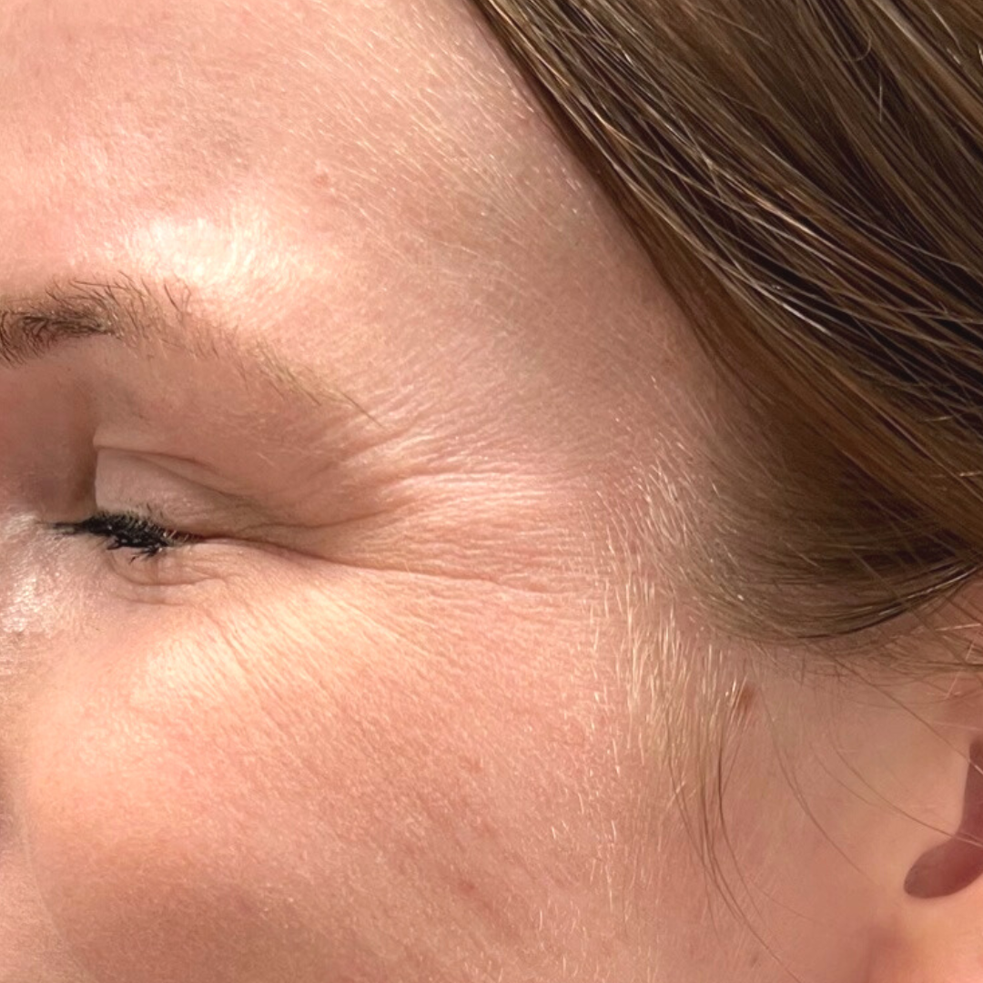 Injectables Before Patient 18