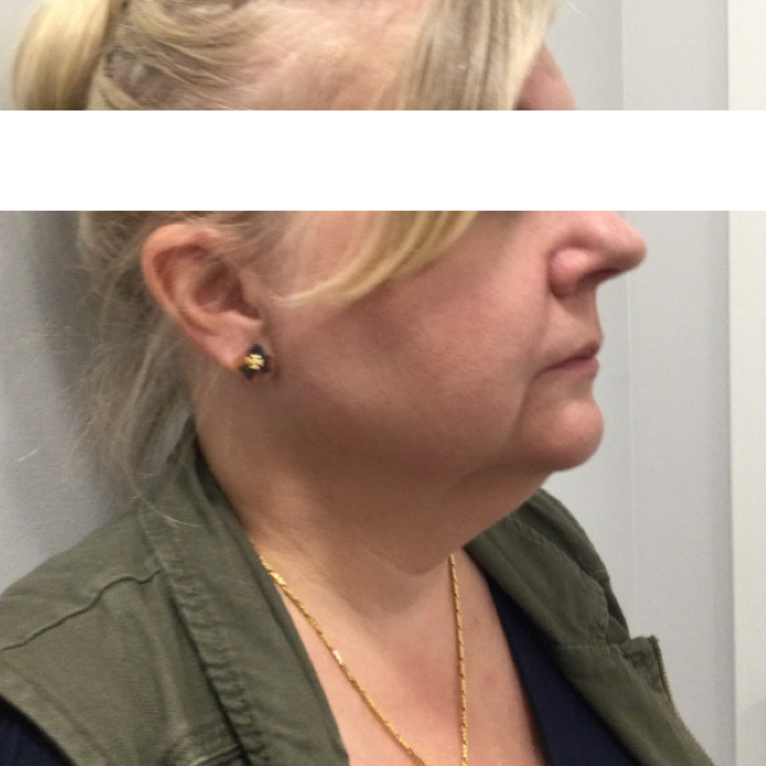 Injectables Before Patient 19