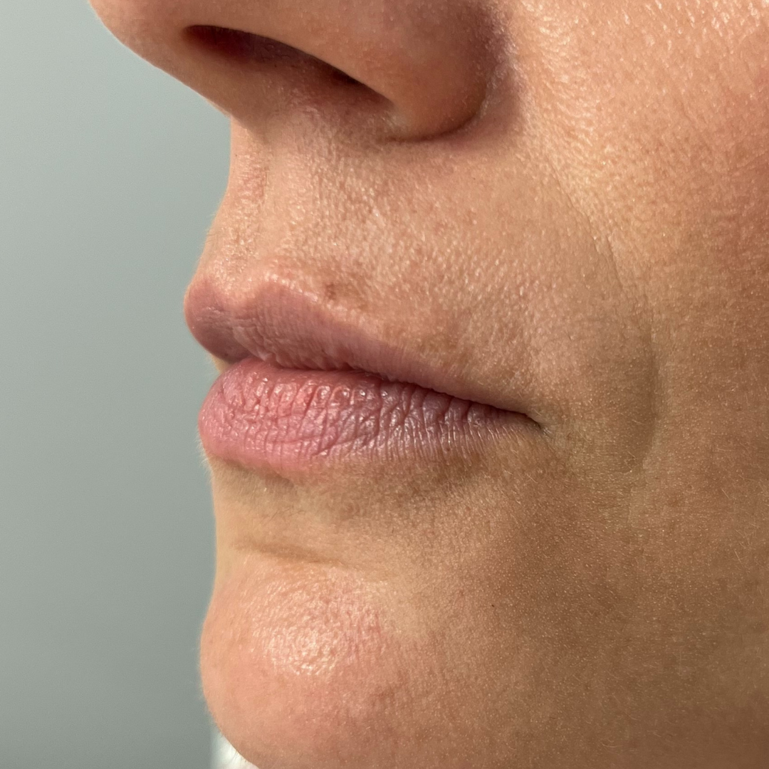 Lip Filler Before Patient 5