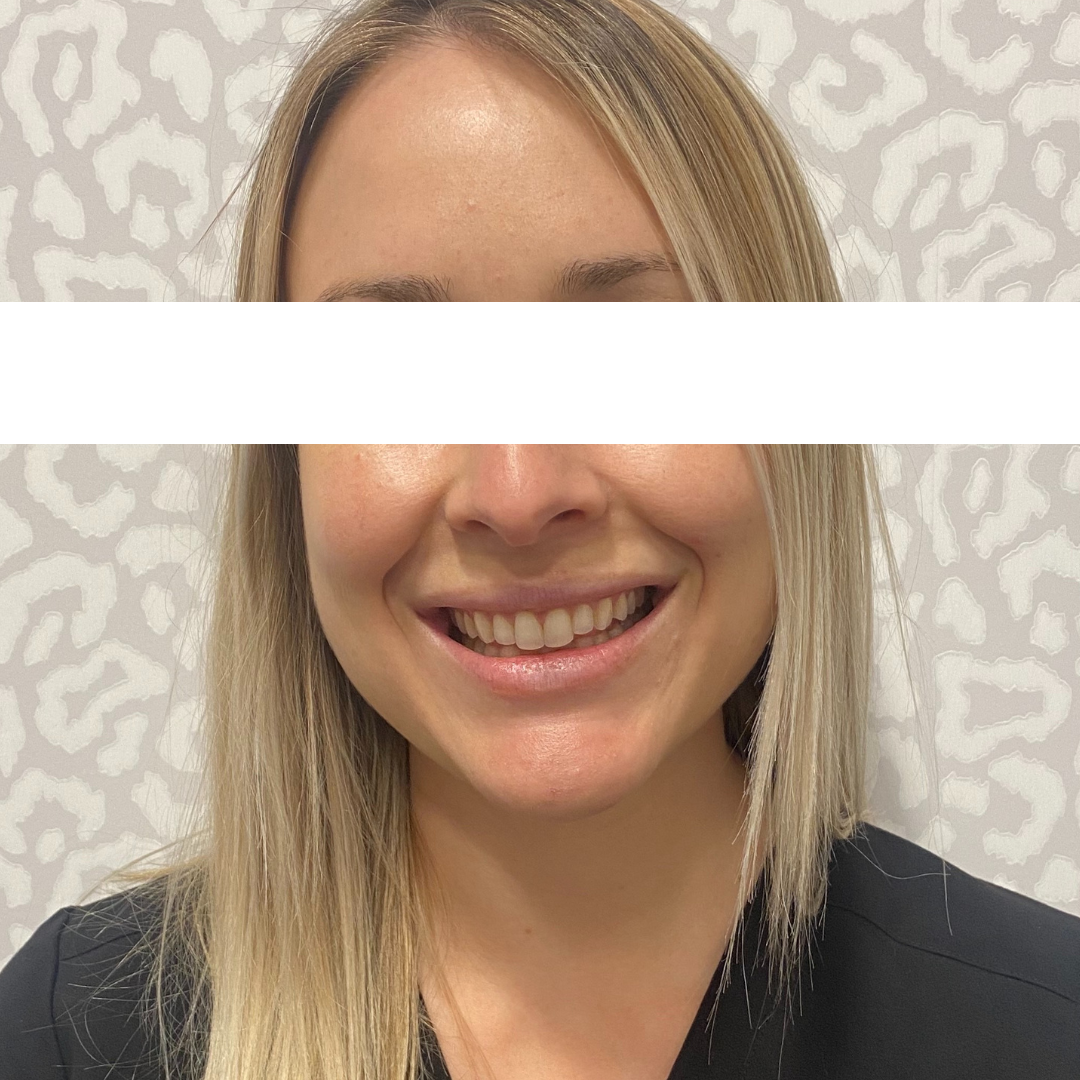 Botox and Dysport After Patient 7