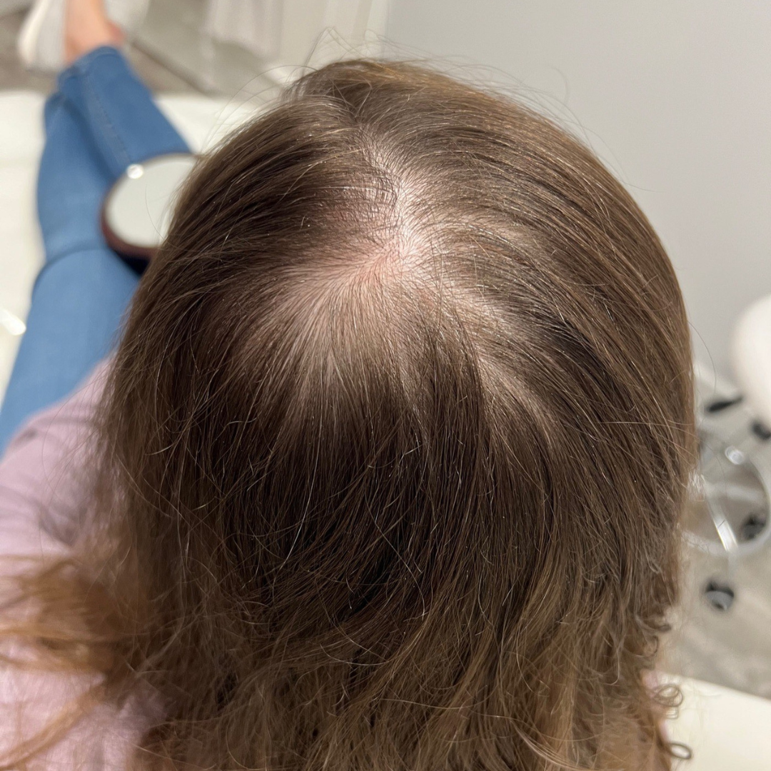 Injectables Before Patient 14