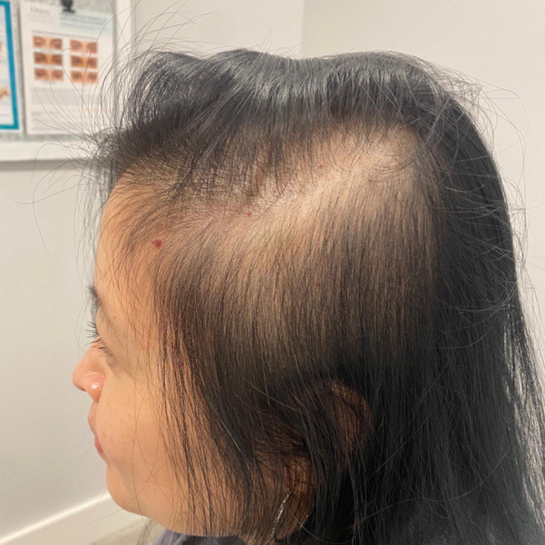 Injectables Before Patient 19