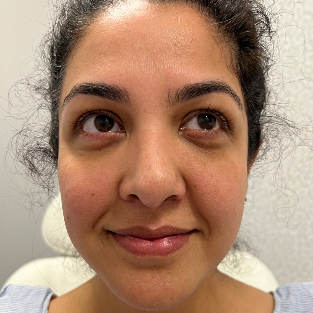 Injectables Before Patient 9