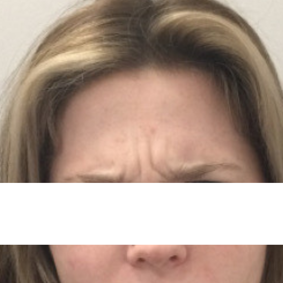 Botox and Dysport Before Patient 12