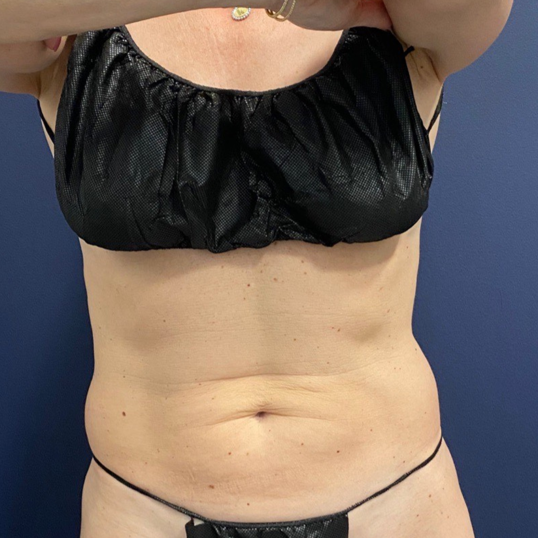 CoolSculpting Before Patient 3