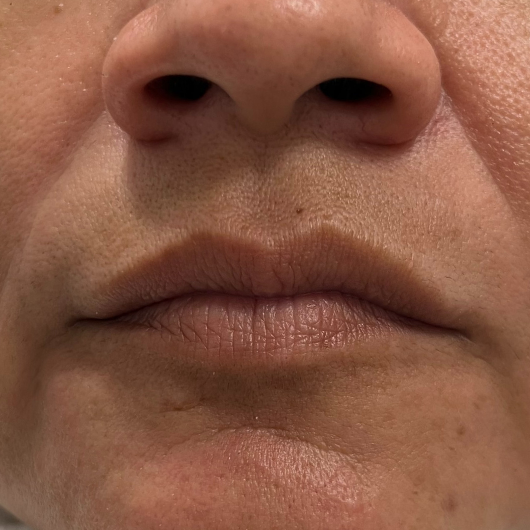 Lip Filler Before Patient 7