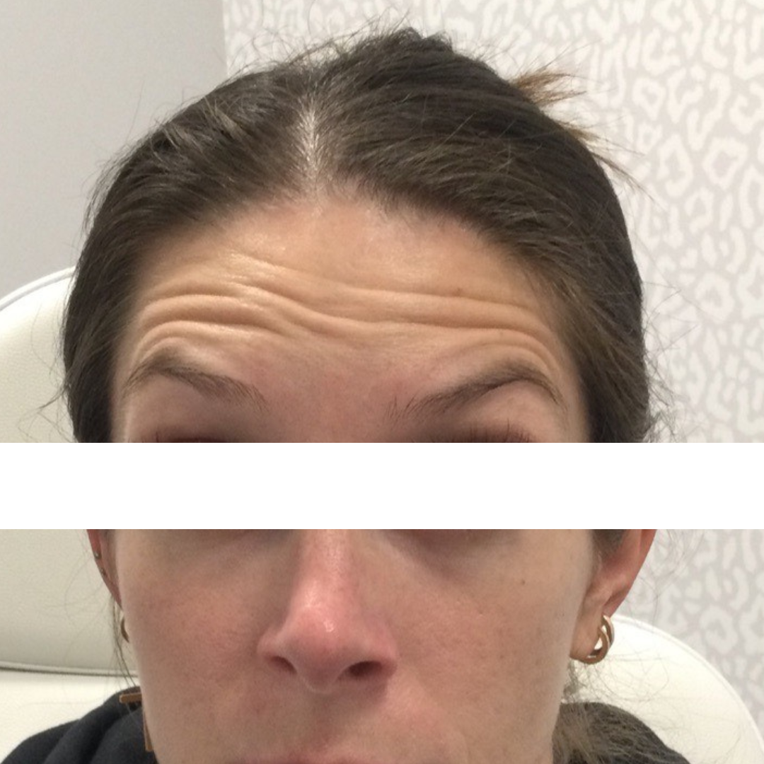 Injectables Before Patient 20