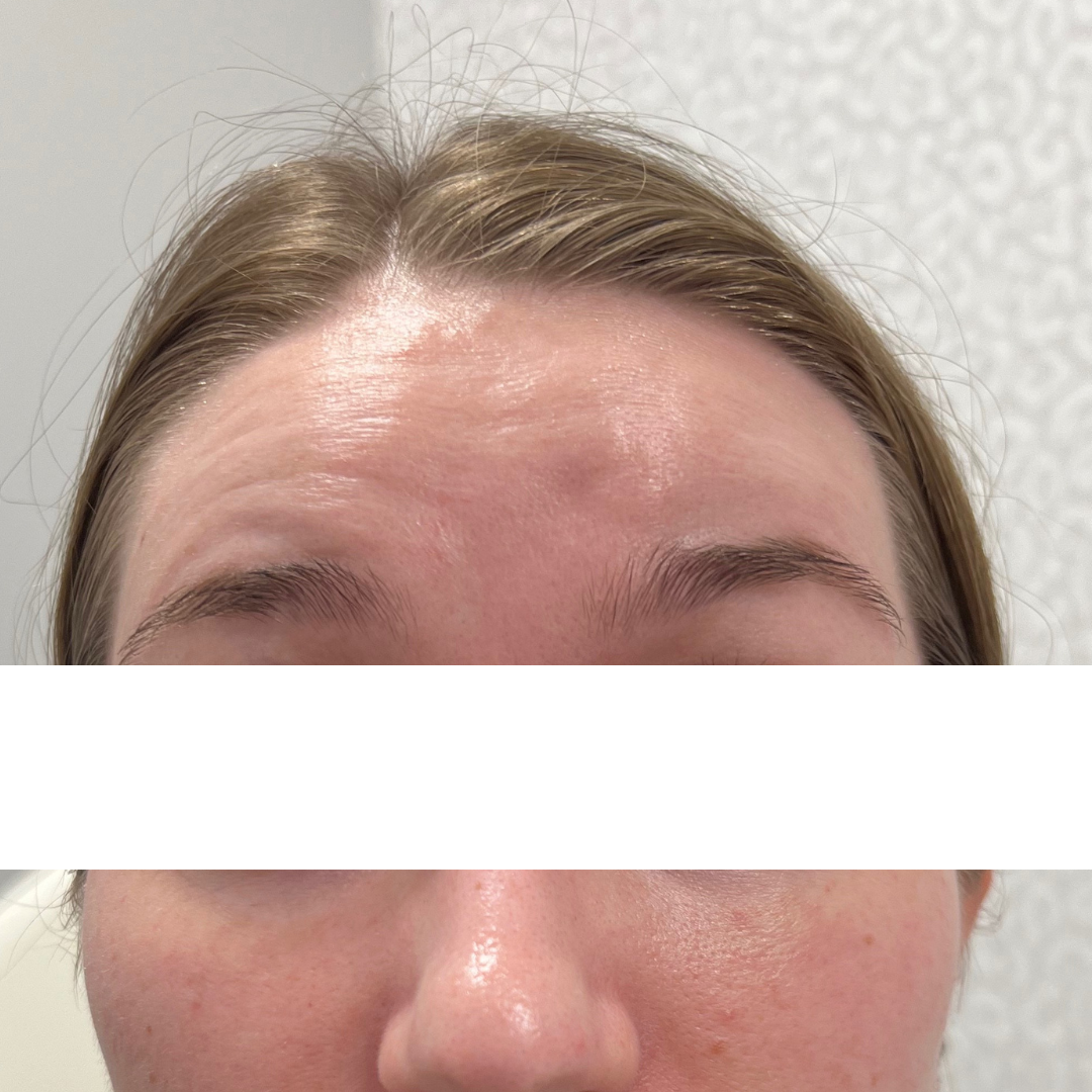 Botox and Dysport Before Patient 2