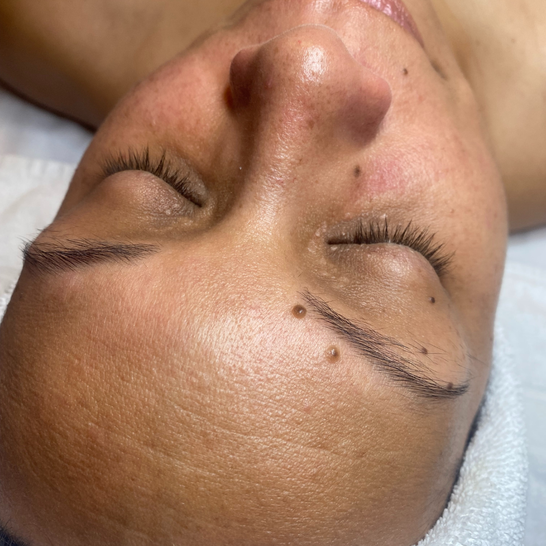 Facials Before Patient 1