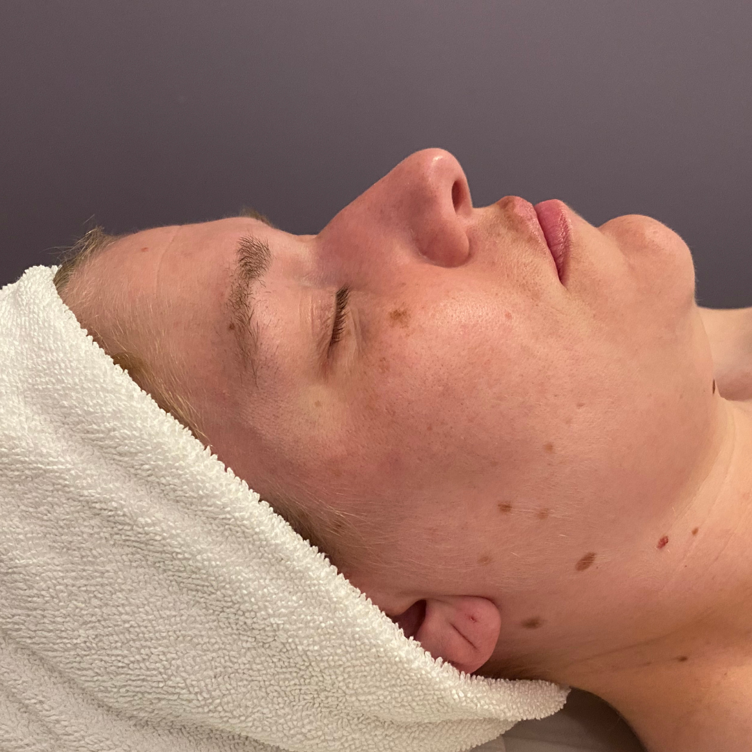 Facials Before Patient 2