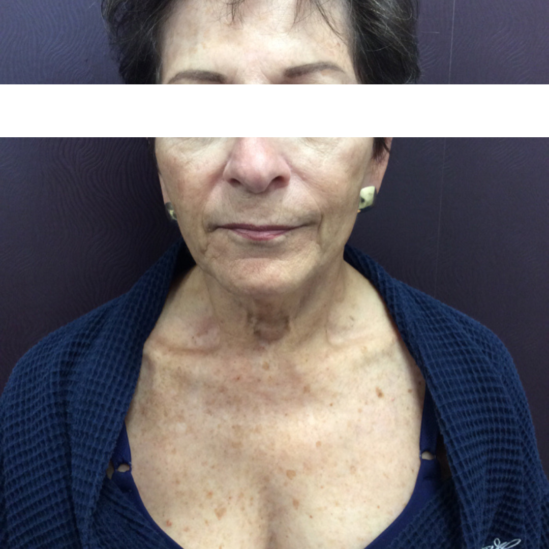 IPL Photo Rejuvenation Before Patient 5