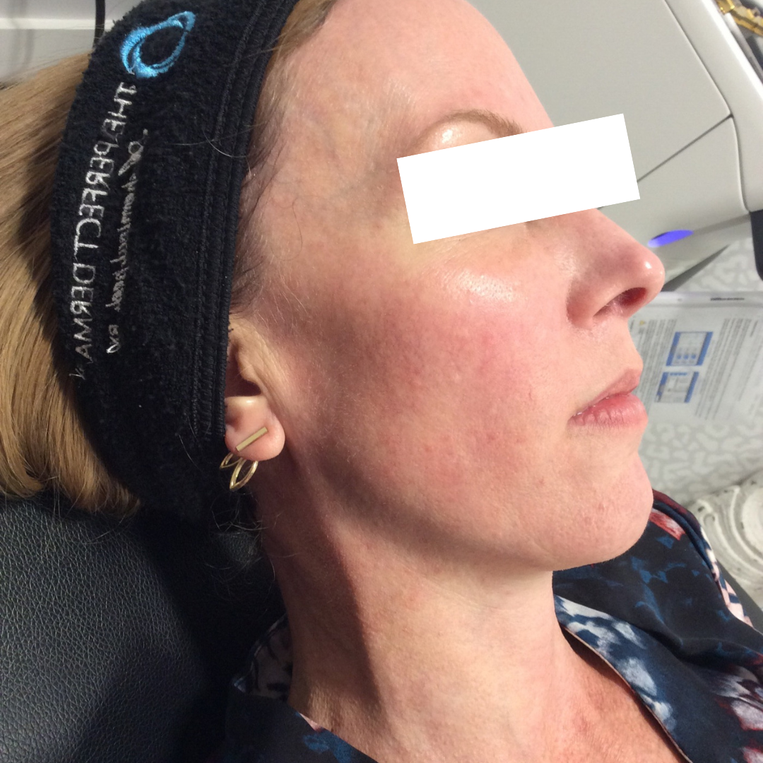 BroadBand Light (BBL) Photo Rejuvenation Before Patient 4