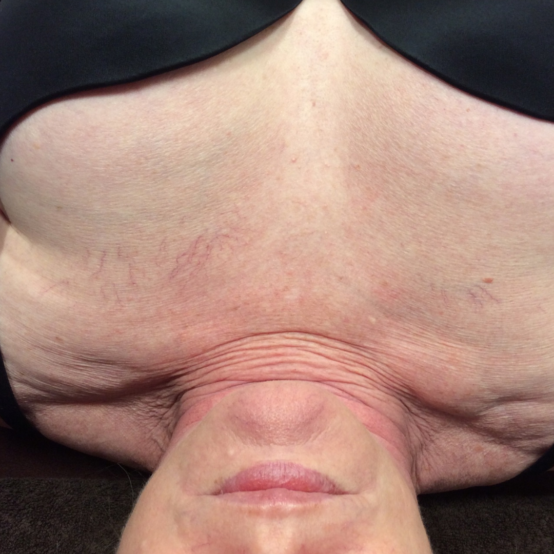 IPL Photo Rejuvenation Before Patient 6