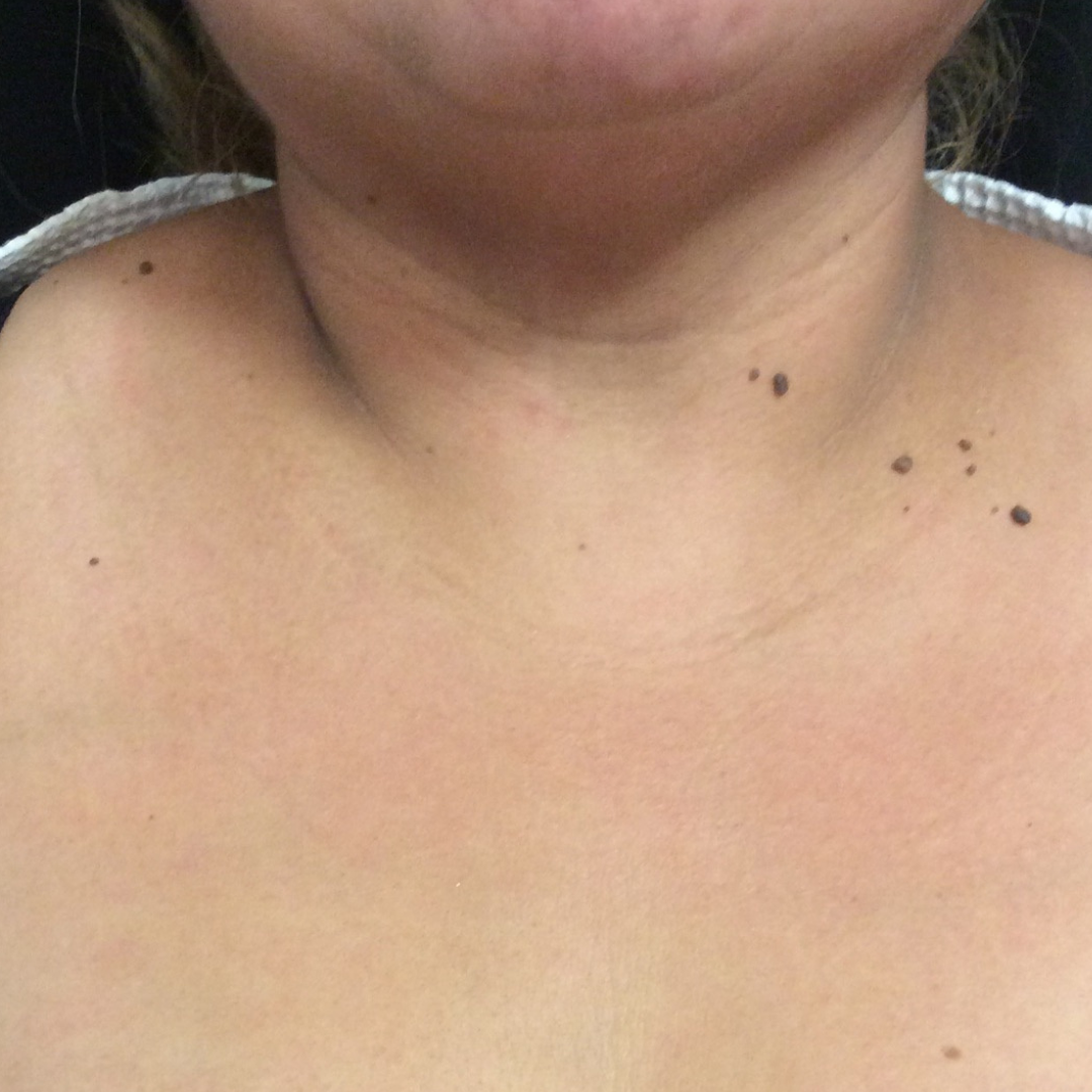 Vein Gogh Before Patient 2