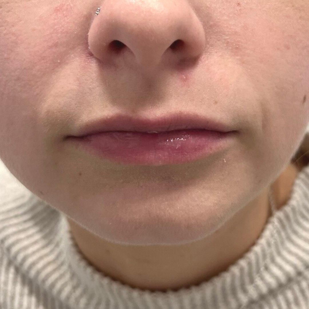 Lip Filler Before Patient 9