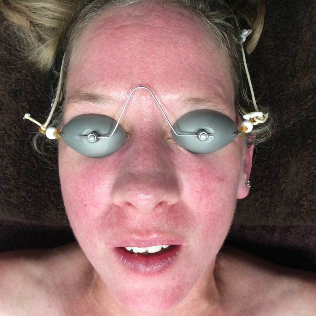 Facials Before Patient 3