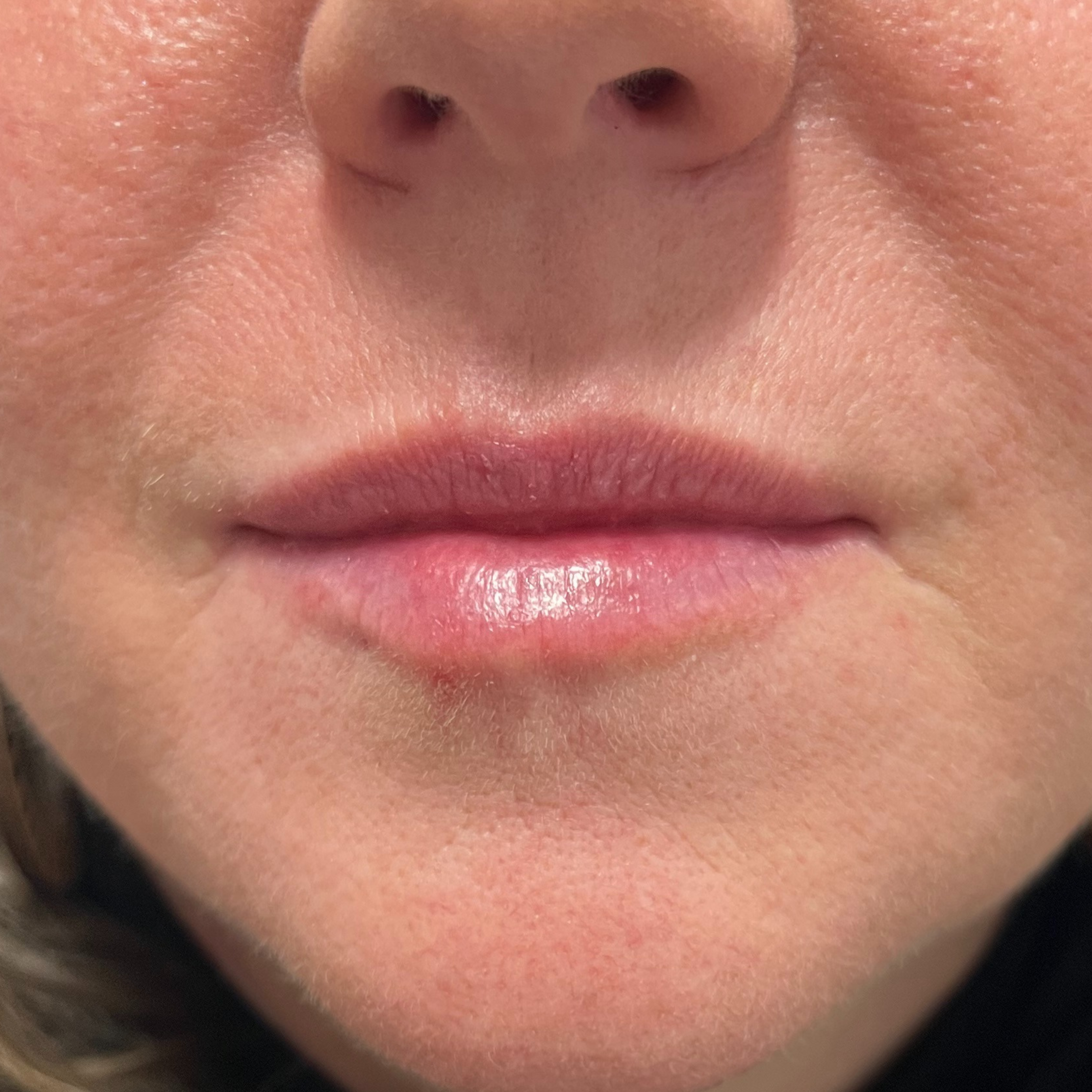 Lip Filler Before Patient 33