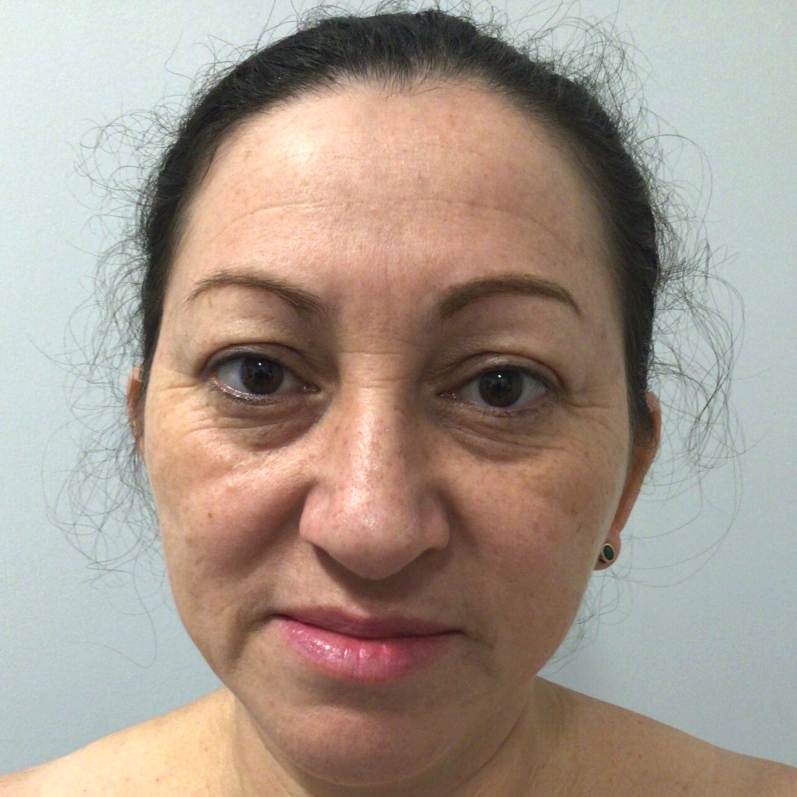 BroadBand Light (BBL) Photo Rejuvenation Before Patient 2