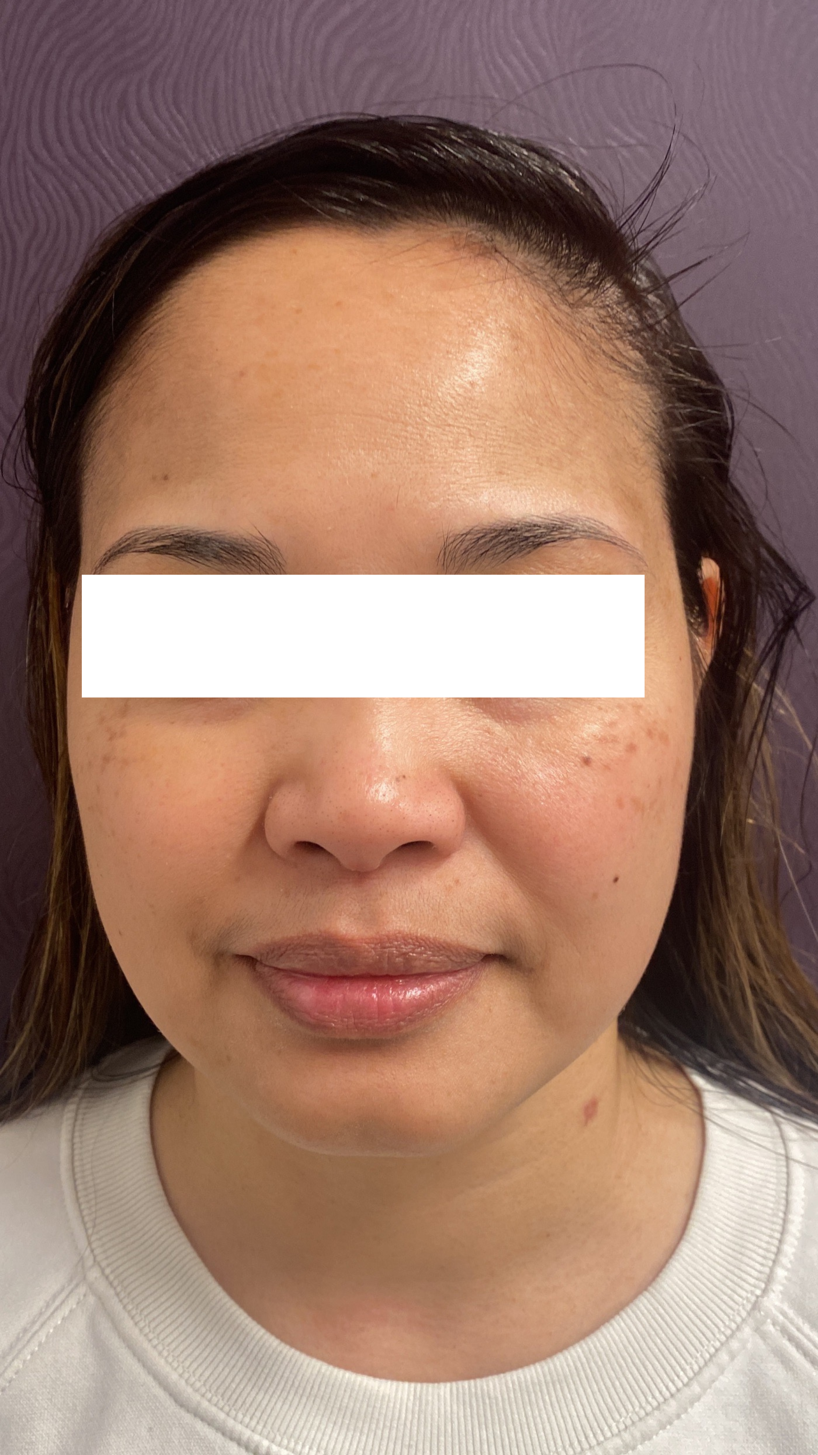 Chemical Peels Before Patient 1