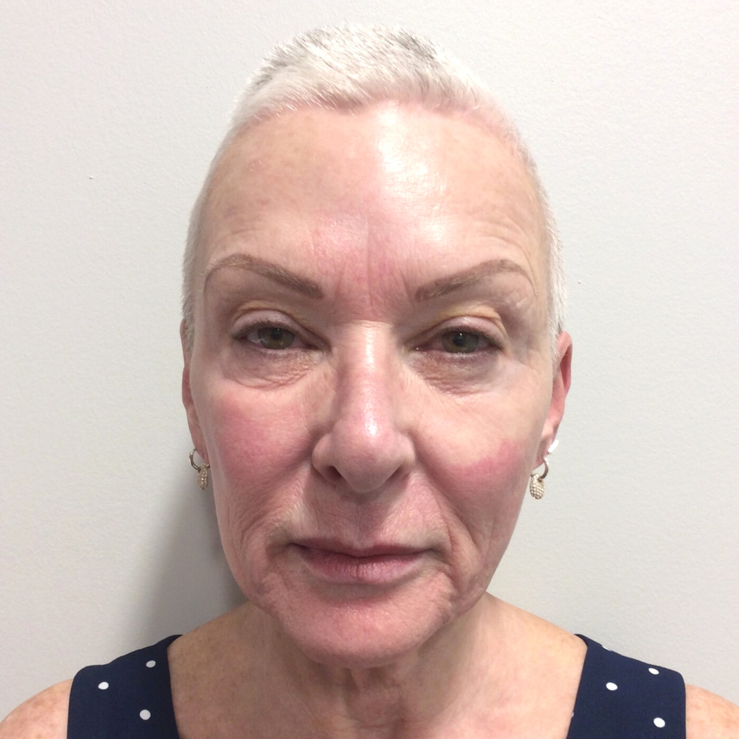 Fraxel Before Patient 1