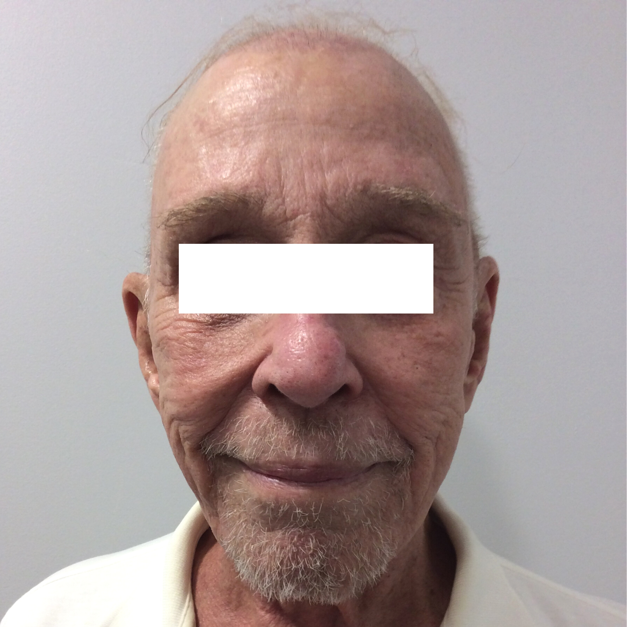 Fraxel Before Patient 2