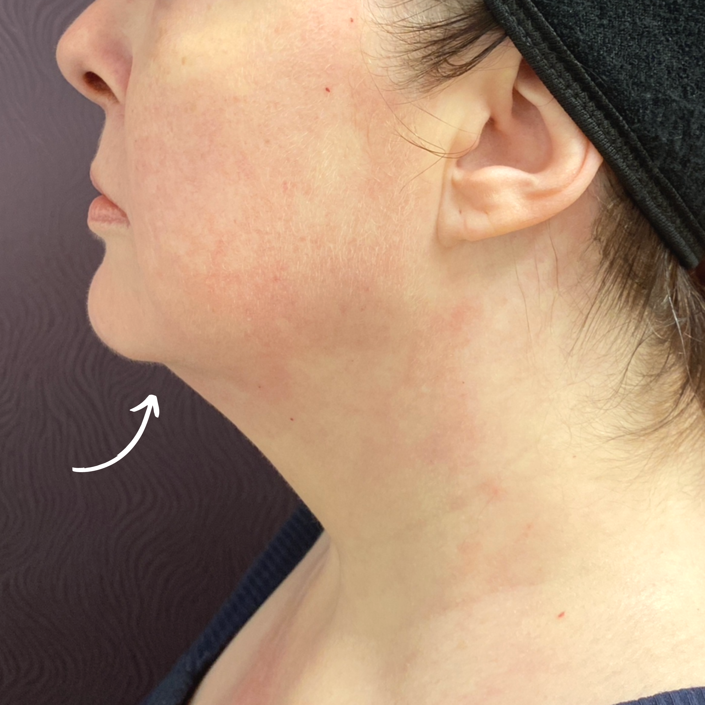 Medical Spa Before Patient 9