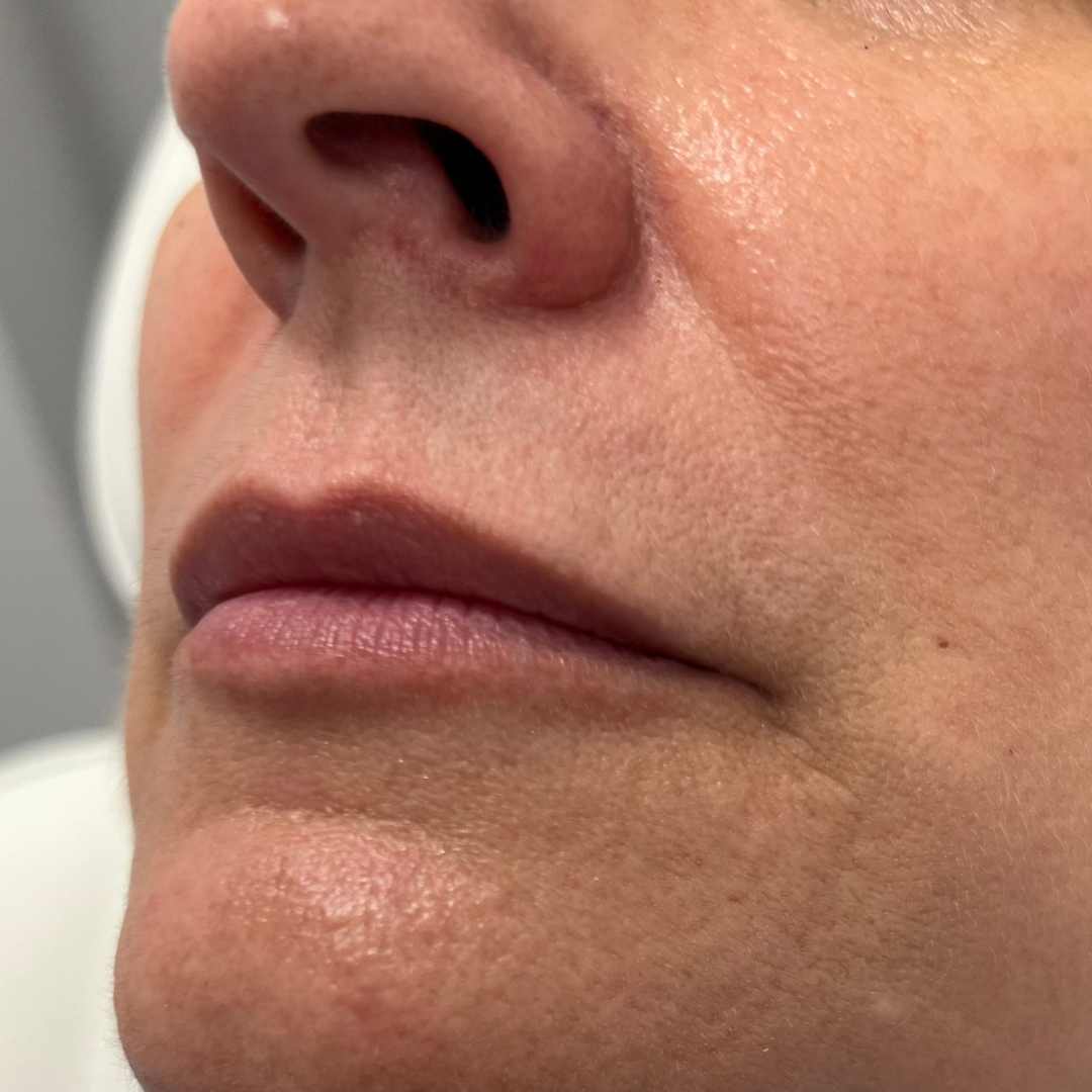 Nasolabial Folds Archives Mountcastle Medical Spa and Laser Center