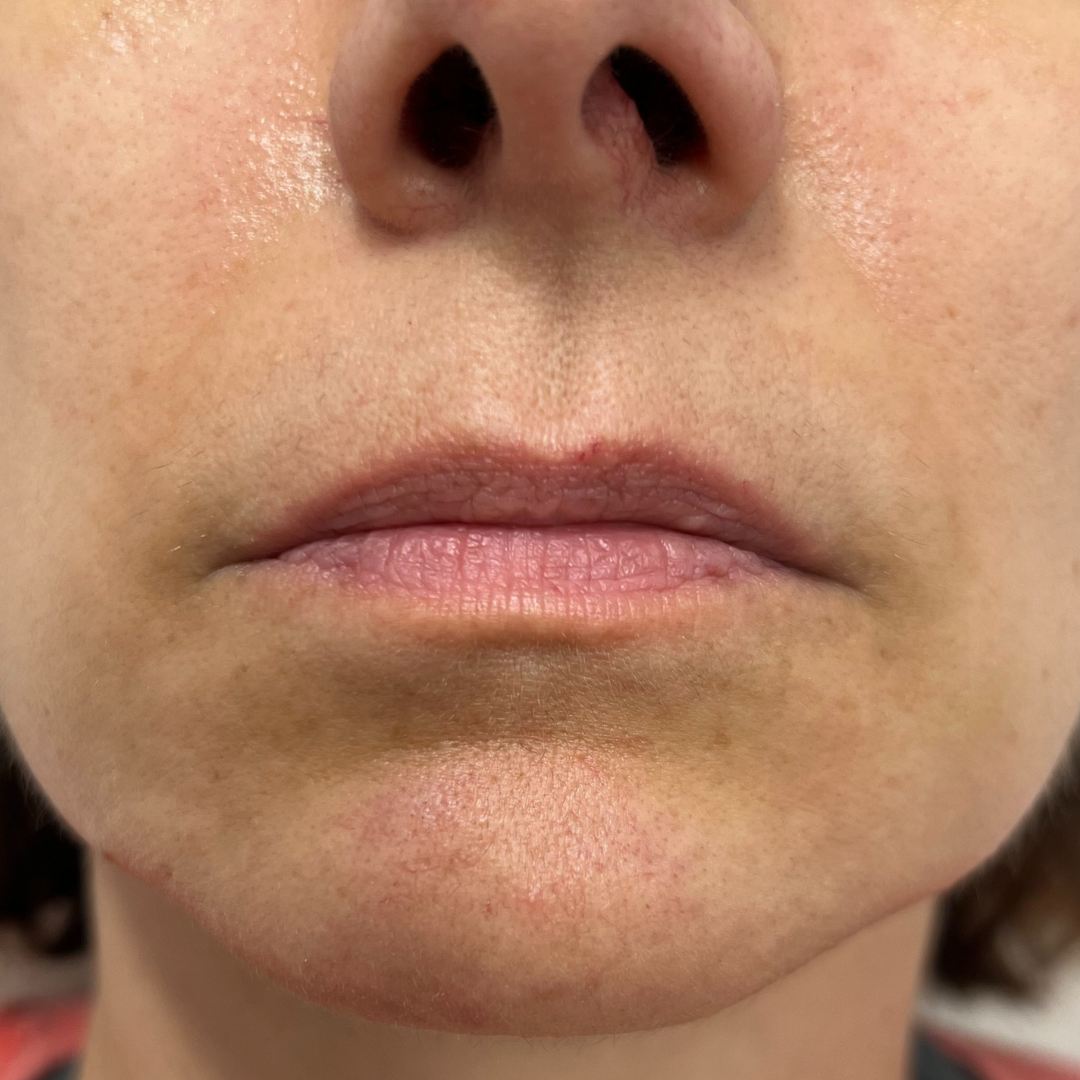 Lip Filler Before Patient 11