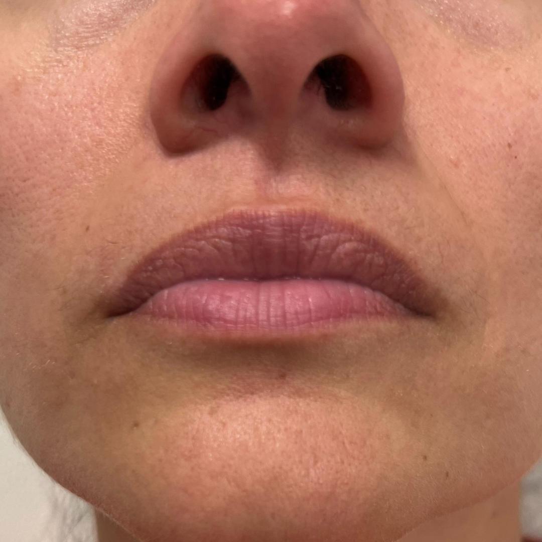 Lip Filler Before Patient 14