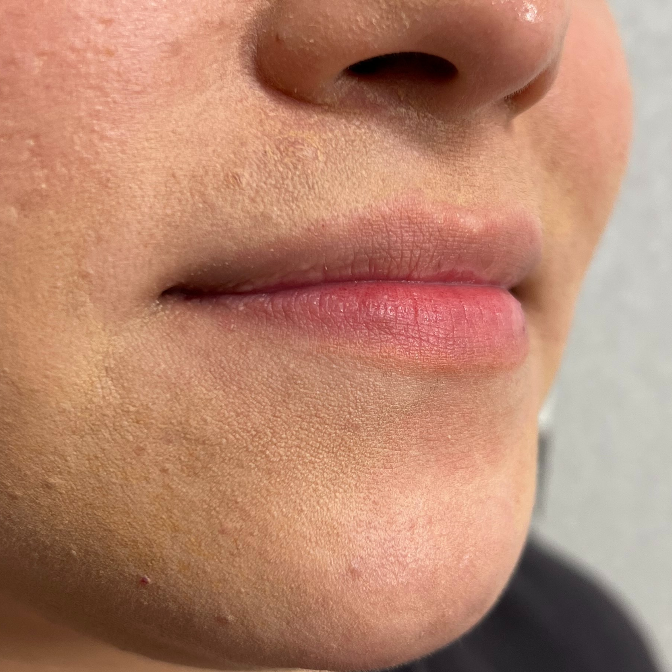 Lip Filler Before Patient 11