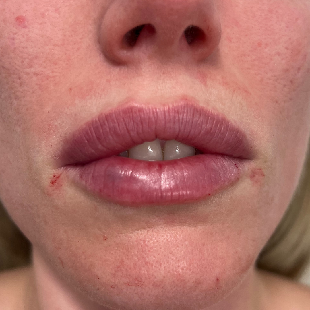 Lip Filler After Patient 21