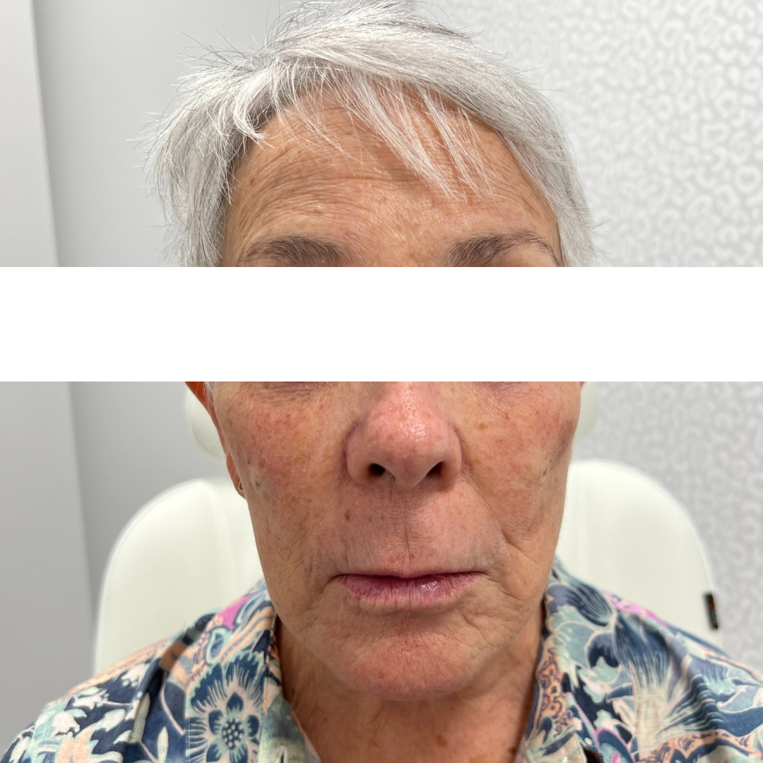 Cheek Filler After Patient 3